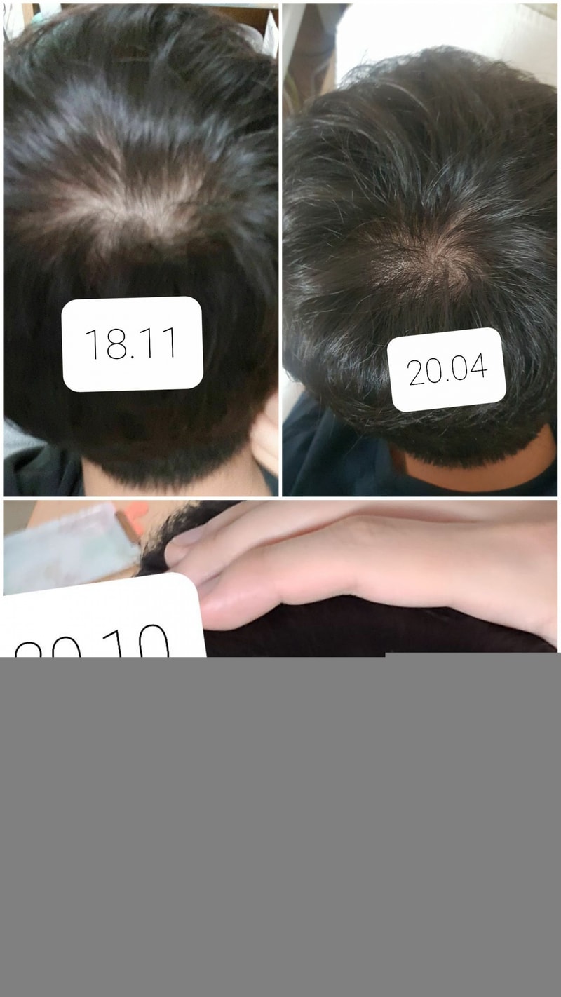 I'm in my second year of Professionalsia. I'm worried about the top of my head