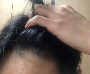 복용 5개월차