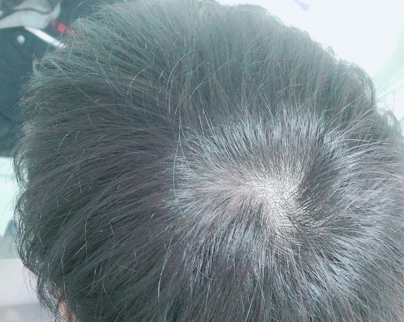 脱毛薬中断1ヵ月後のレビュー