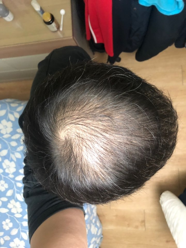 탈모치료 8개월차