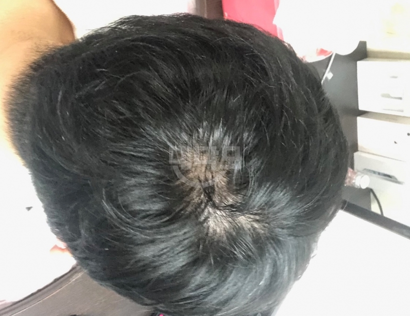 25岁的男人开始了后期