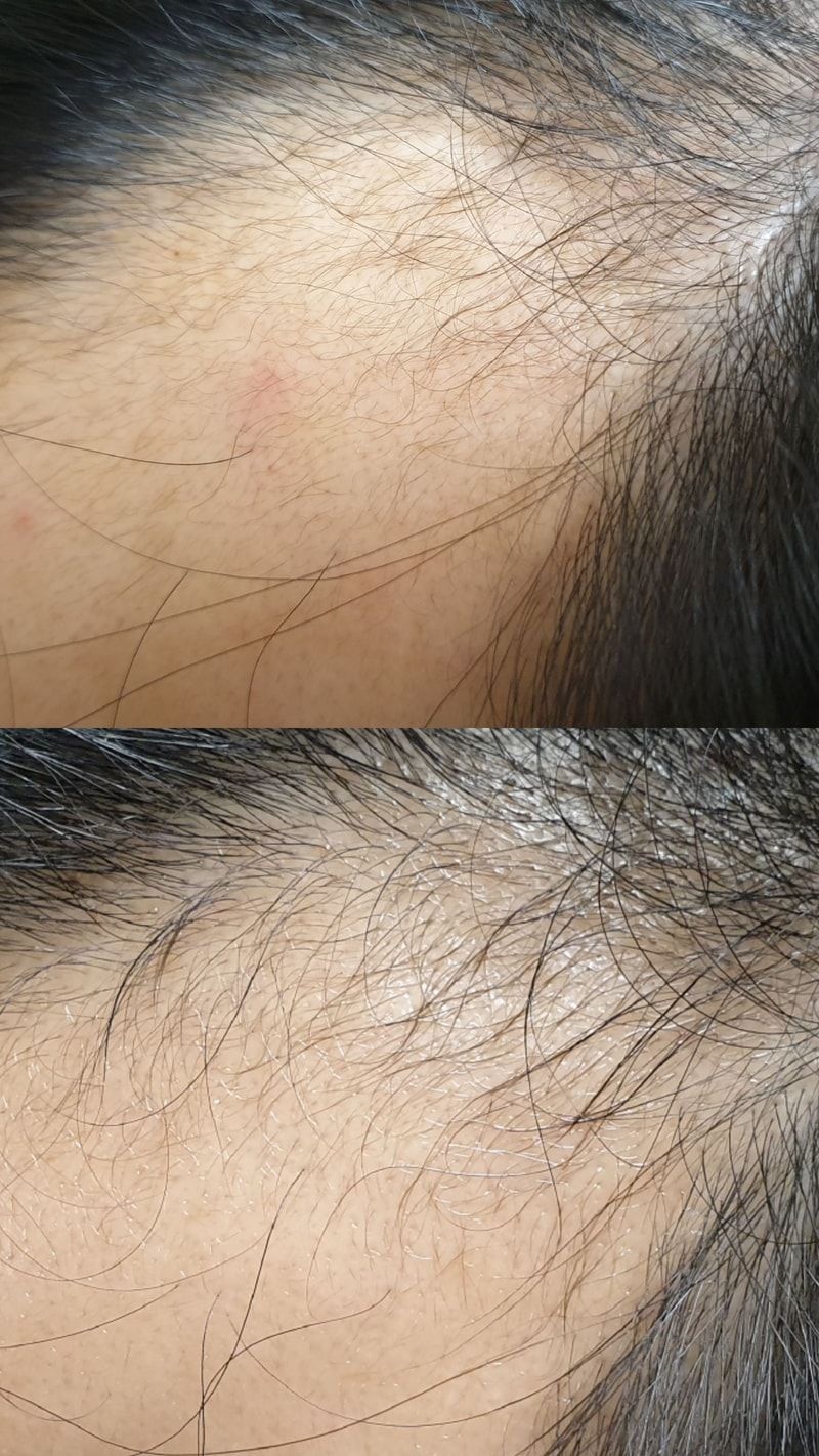 是服用头陀的2.5个月后期。