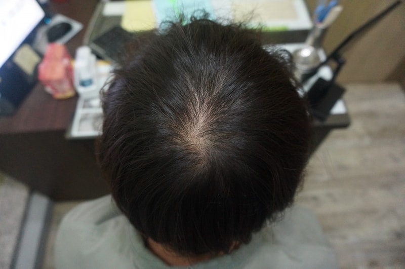 I'm taking Propecia for 16 months. Should I change my medication?