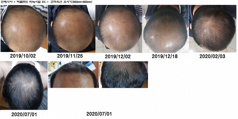 탈모 13년차의 탈모일지 8.5개월차