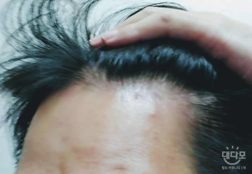 초반 한의원 문의 옆머리