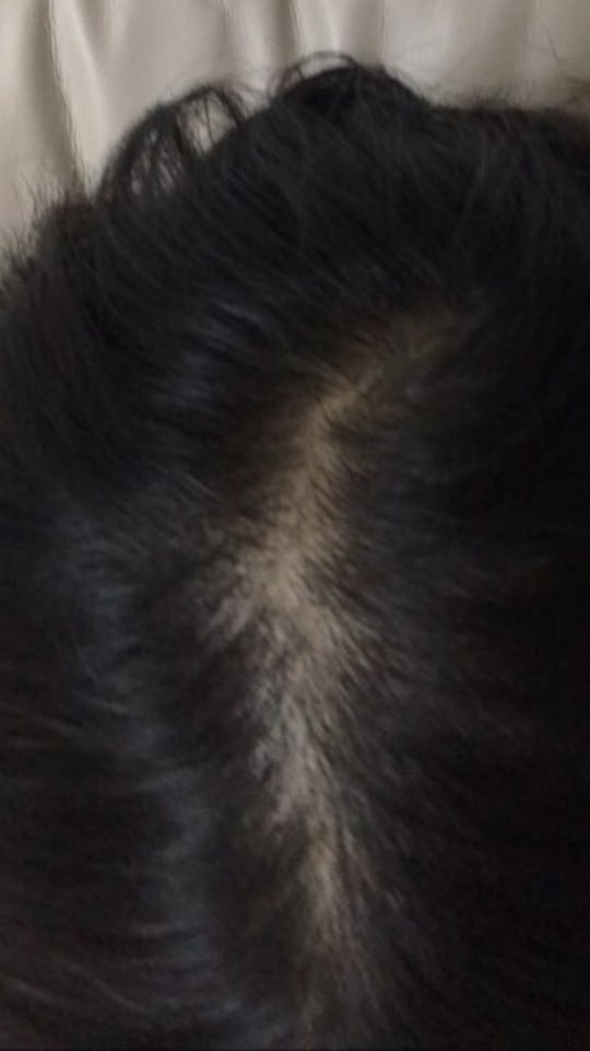 1 month review of Minoxidil, a high-grade hair loss drug