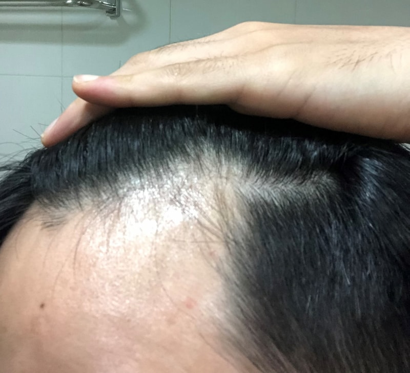 阿凡达+米诺西地尔5个月后期。