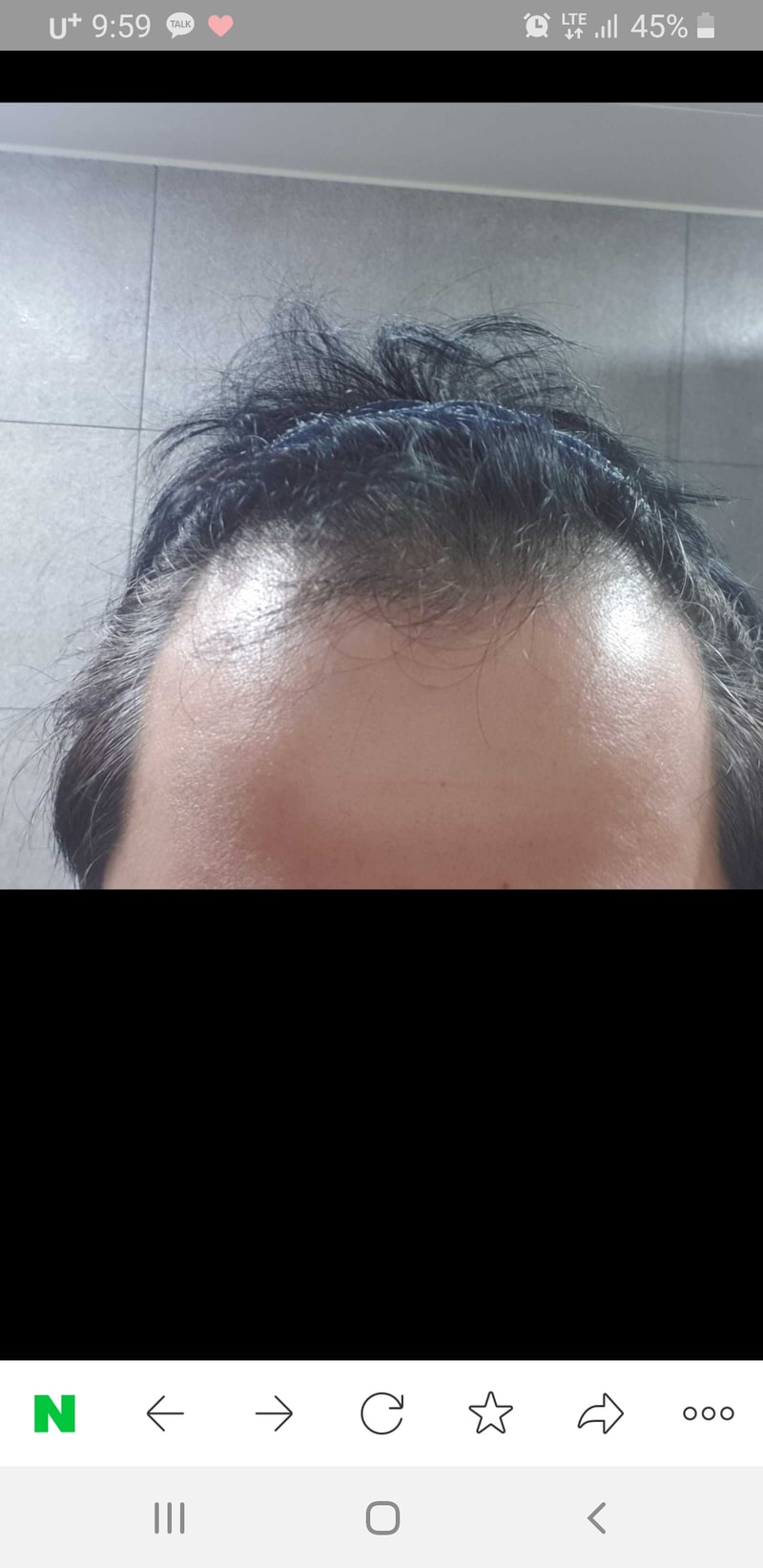 핀페+미녹시딜정 9개월 복용중입니다.