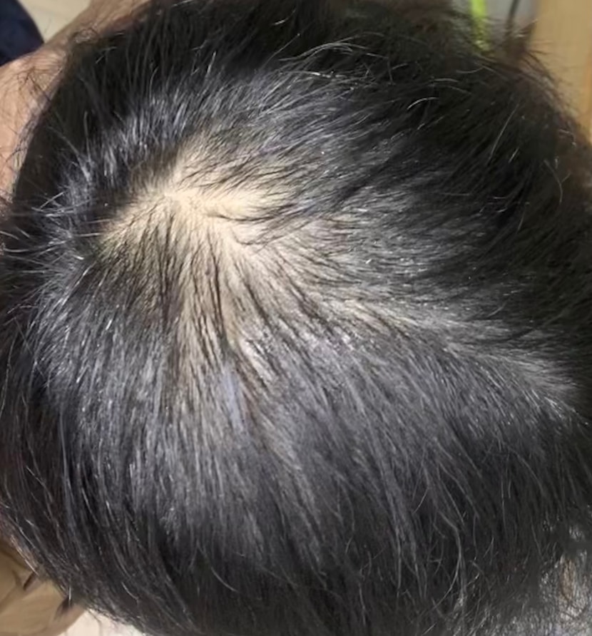 올해초 미녹뿌린 직후입니다. 