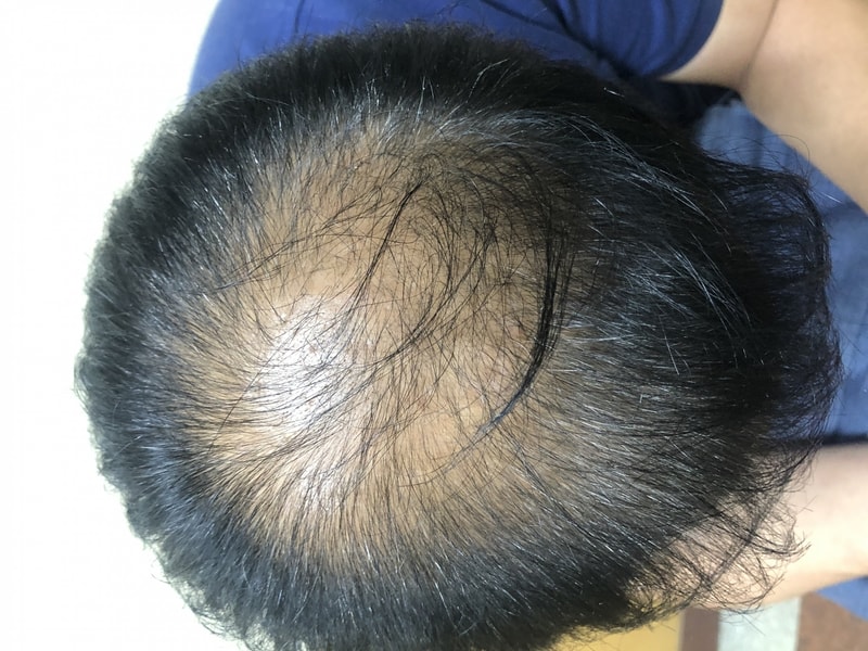 탈모치료 1년의 변화