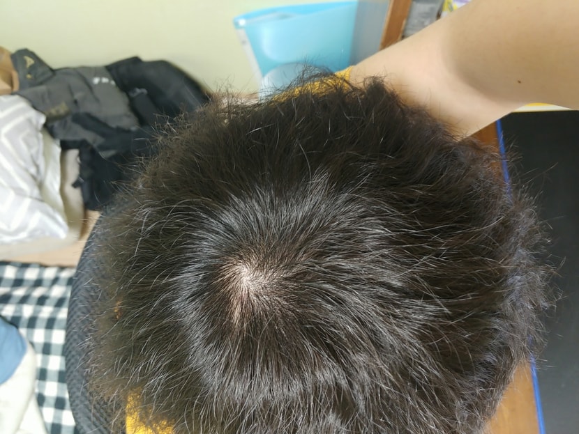 복용 1년차 방금찍음