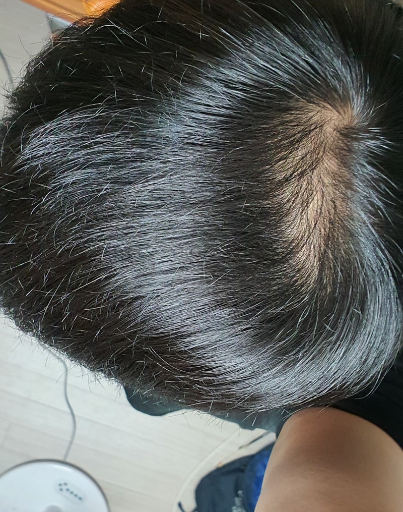 AGA治療薬1年5ヶ月の体験談？