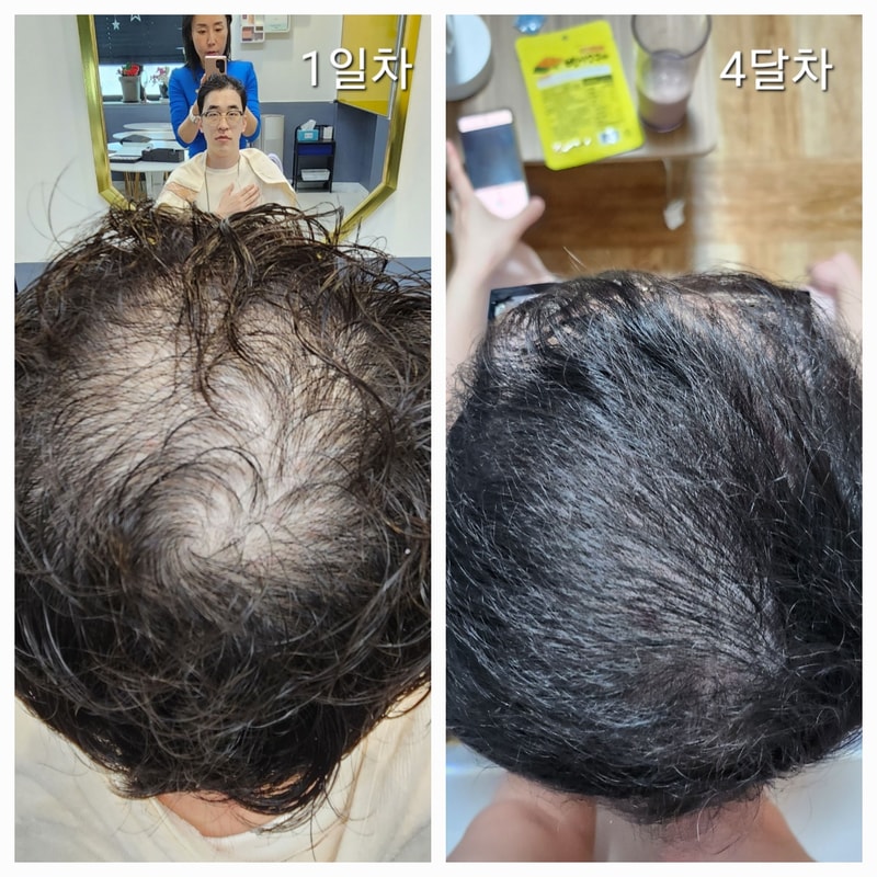 AGA治療薬のフォト体験談です。