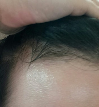 왼쪽  (기름진건 약 발라놔서 그렇습니다)