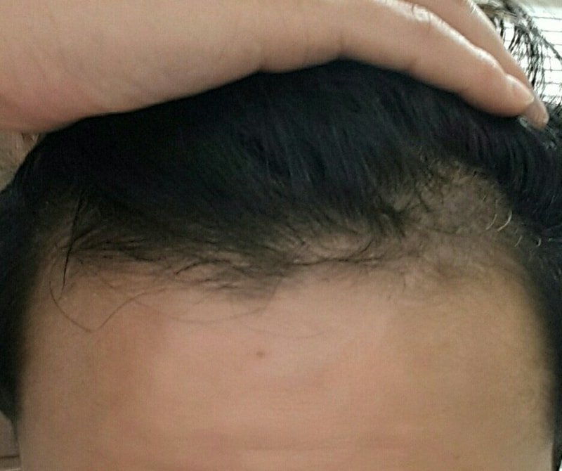 충북대 처방9개월차 꼭 한번봐주세요 ! 사진있음