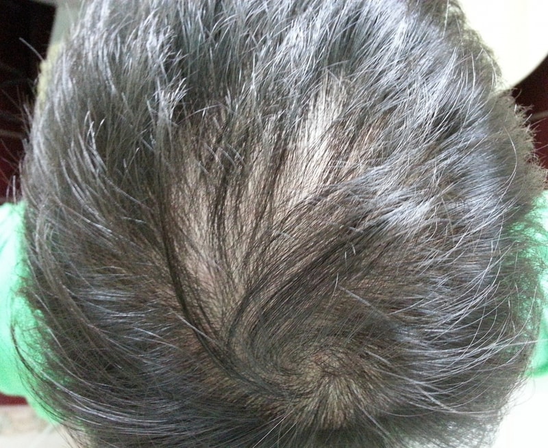 Propecia 3周+ Phydeal 2个月