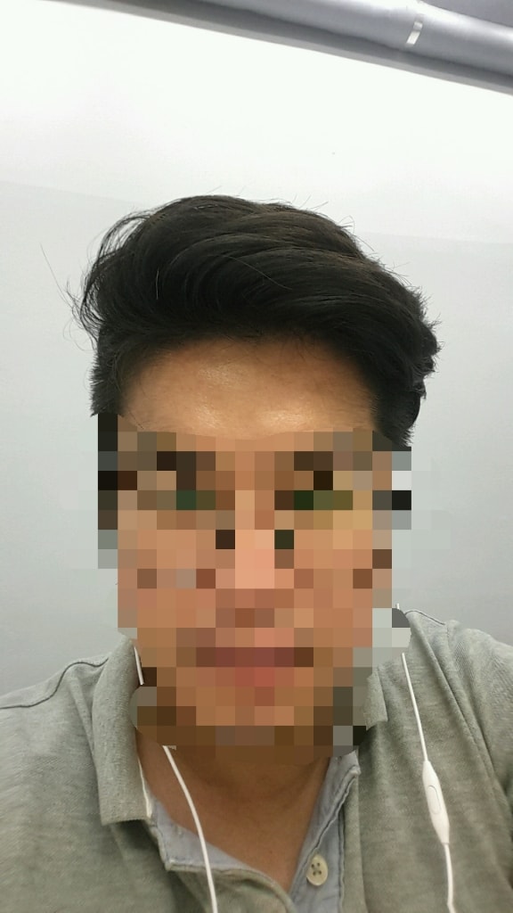 主持人不会停止。 只是用minoxidil来遮挡。