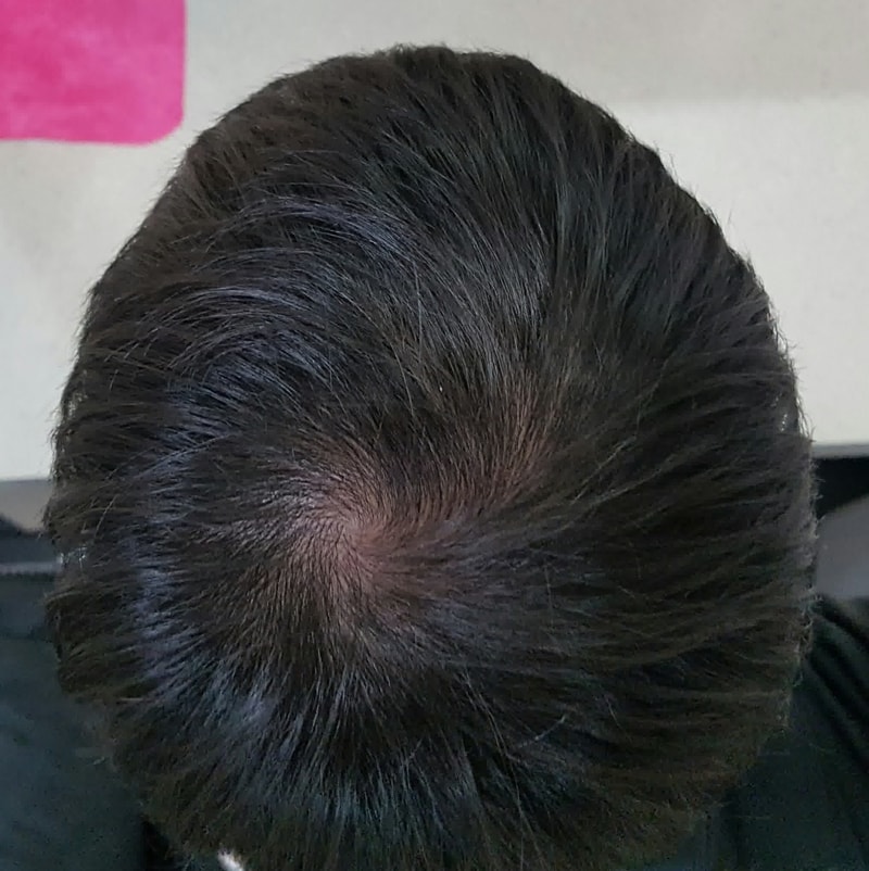 피나스타 8개월 프로스카 1개월