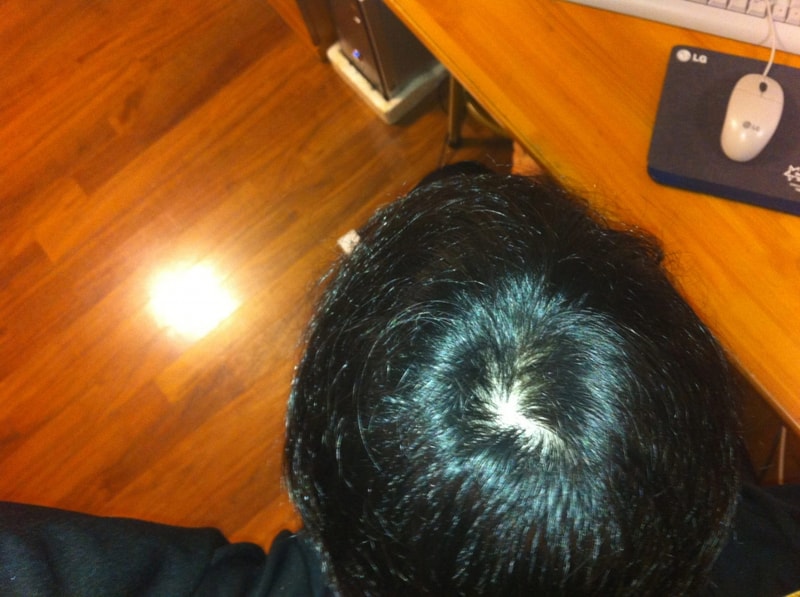 미녹시딜+프로페시아 8개월..