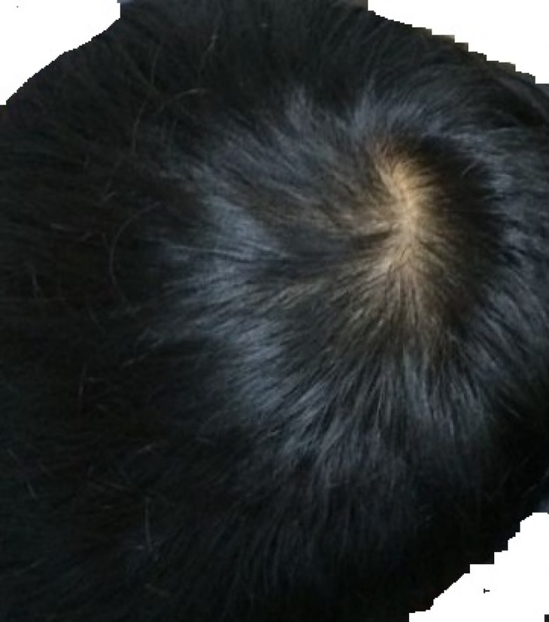 프로스카 25개월 복용 후기