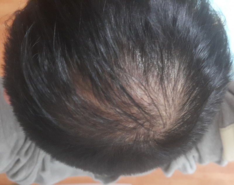 杜他司替利（阿伏特）+米诺地尔2年6个月使用后记。