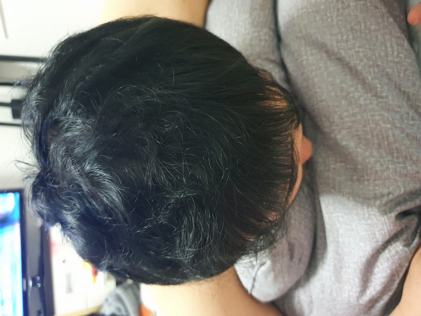 복용 후 170일 정도 된 사진 입니다