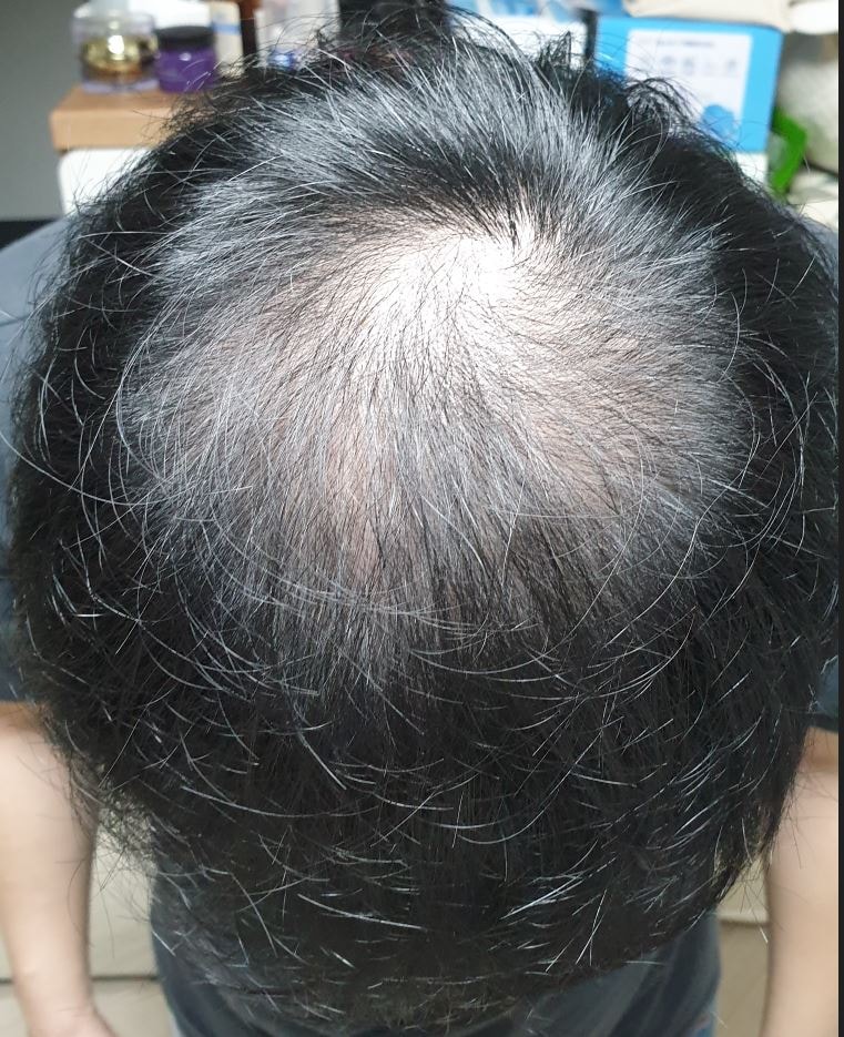 정수리