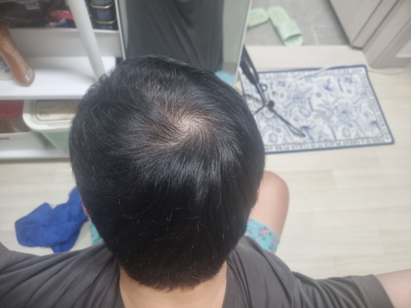 [정수리 탈모] 에프페시아 라무몰에서 구매복용후기