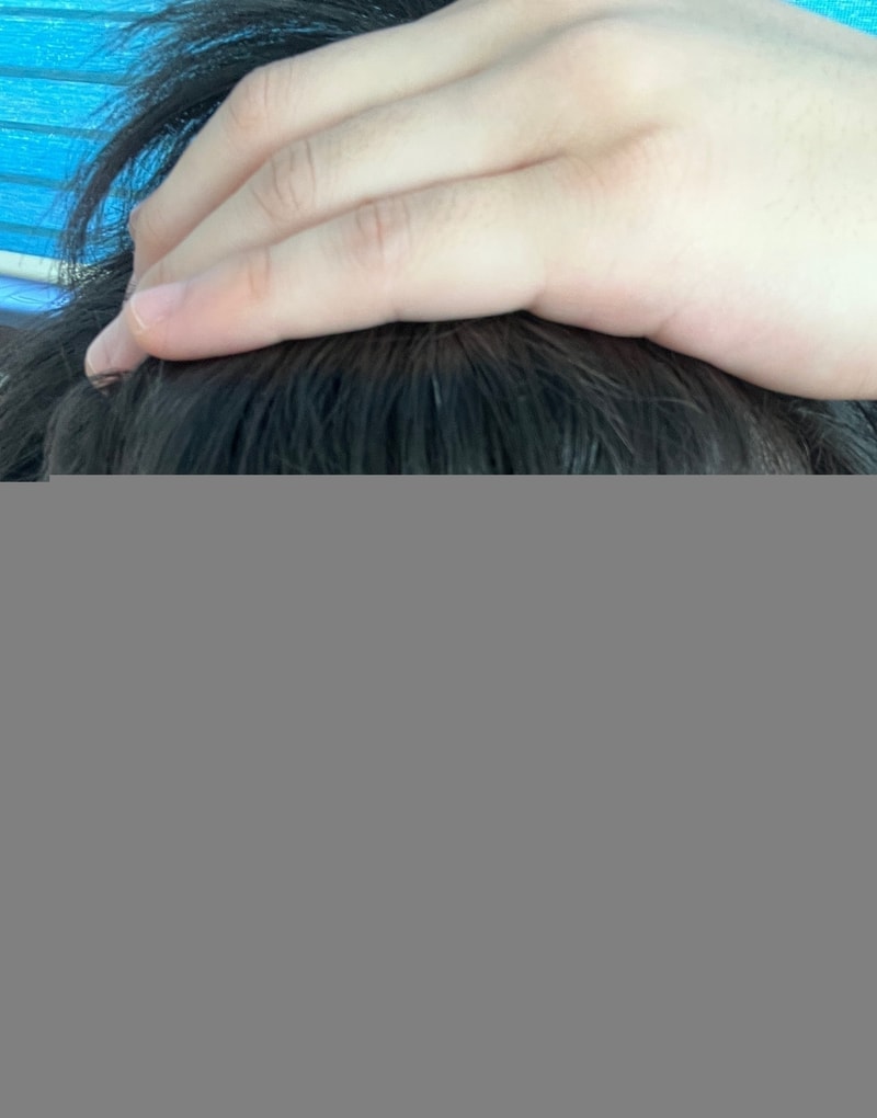 [Profesia] 2 years of taking hair loss medication (feat. side effect experiment)