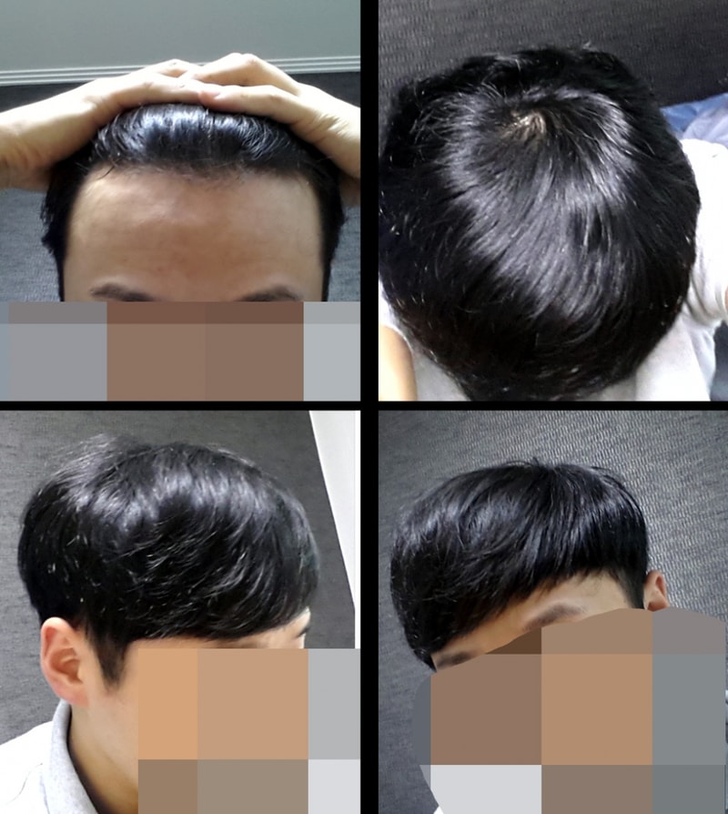 프로페시아 약 2년 7개월 복용중입니다.