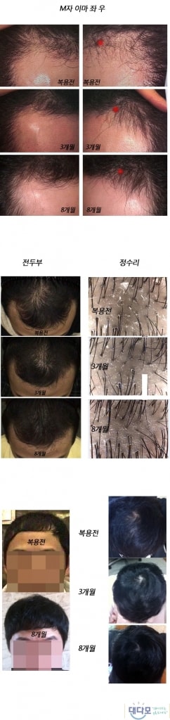 Propecia服用约1年零5个月。