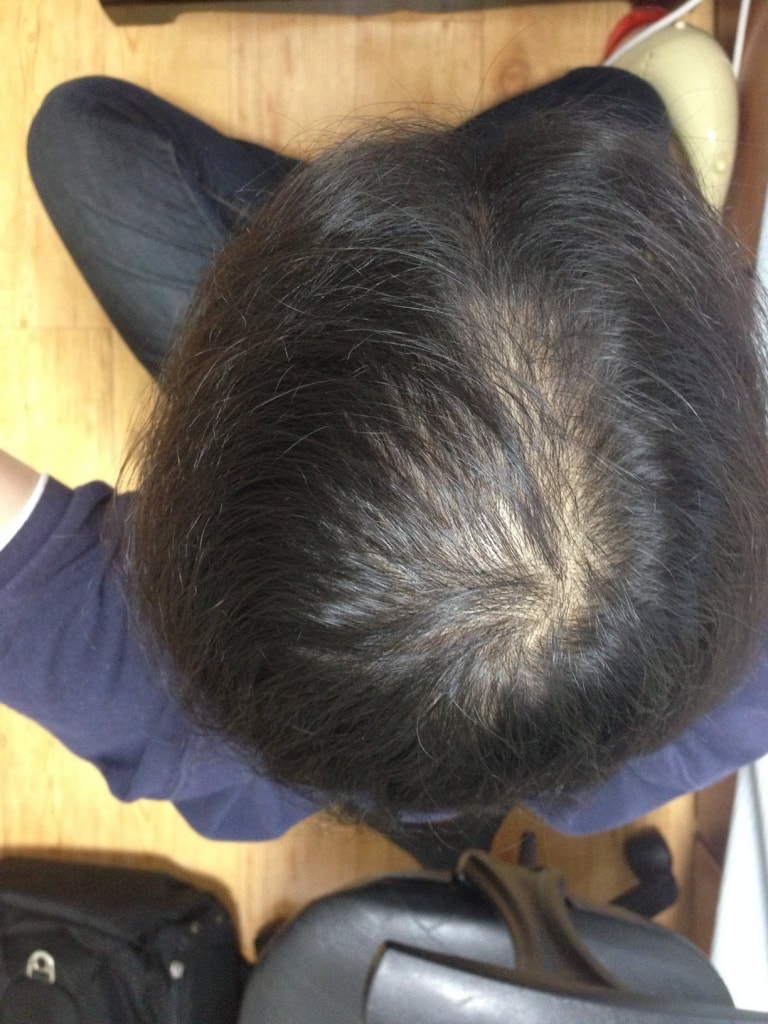 복용 90일째 - 드라마틱합니다