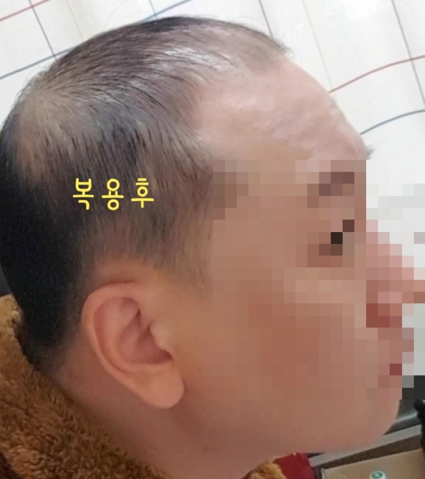 복용후