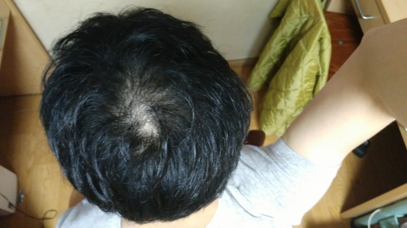 Propecia 1年2个月后期