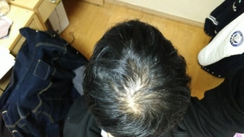 엄청난 쉐딩으로 정수리 머리털 소멸