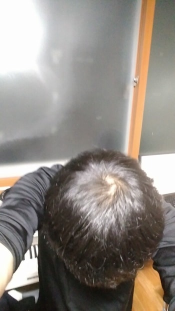 현재 (1년 2개월 복용)