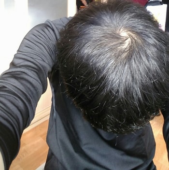 현재(1년 2개월 복용)