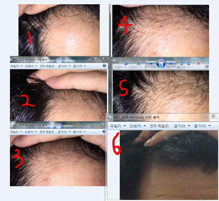 M자 탈모 3달 조금 넘었네용