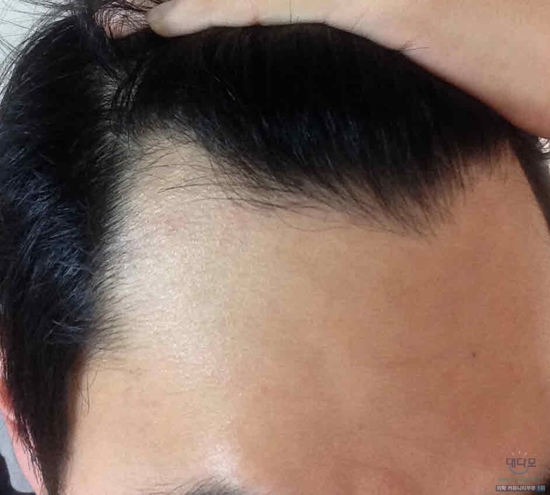 와 미녹시딜 장난아닌데요?