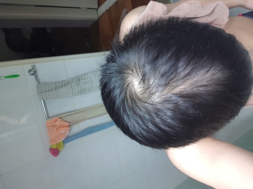 이건 6개월째인데 이쯤 미녹시딜 좀 많이바르니 모발도 얇아지고 뾰루지생기고 해서 이거 이후에는 복용량을 줄였습니다 가르마가를때입니다