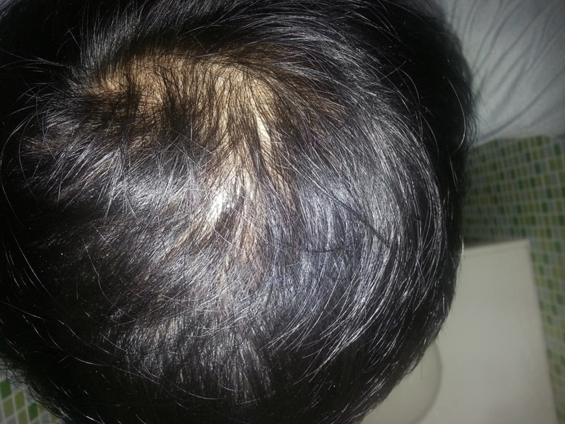 服用芬那斯特里德仿制药1年9个月（21个月）后记