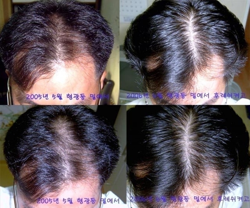 사진과 함께 프로스카 1년 사용후기입니다.