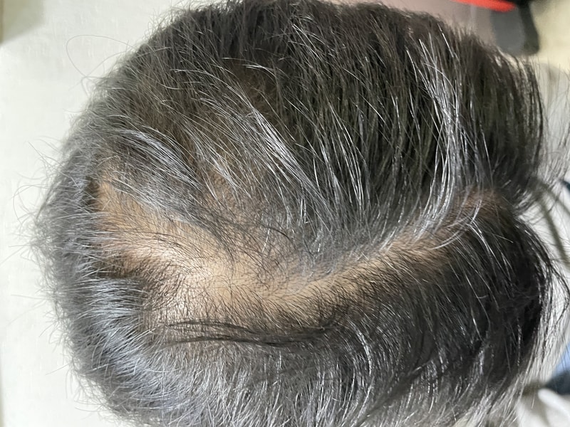 바로피나정 5개월