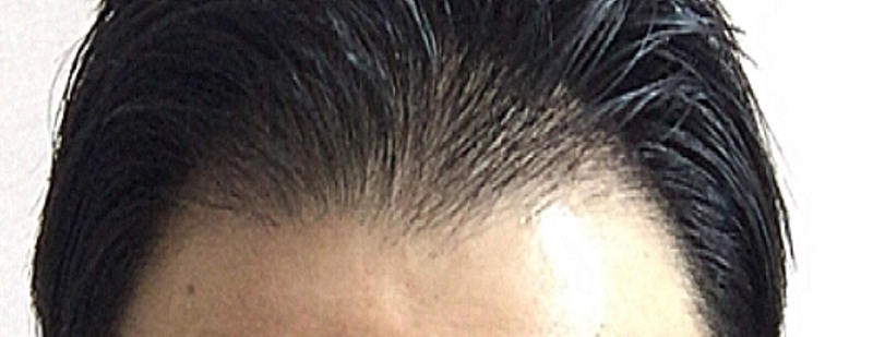 Propecia + Minoxidil 69th day