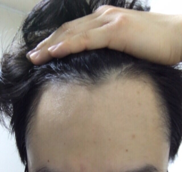 Propecia + Minoxidil 3个月 3周后期