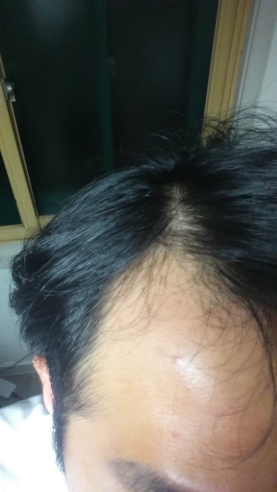 Dutaminok + @ 1年后期