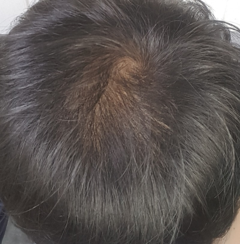 头顶内蛋发 Monad Jung 3个月后记