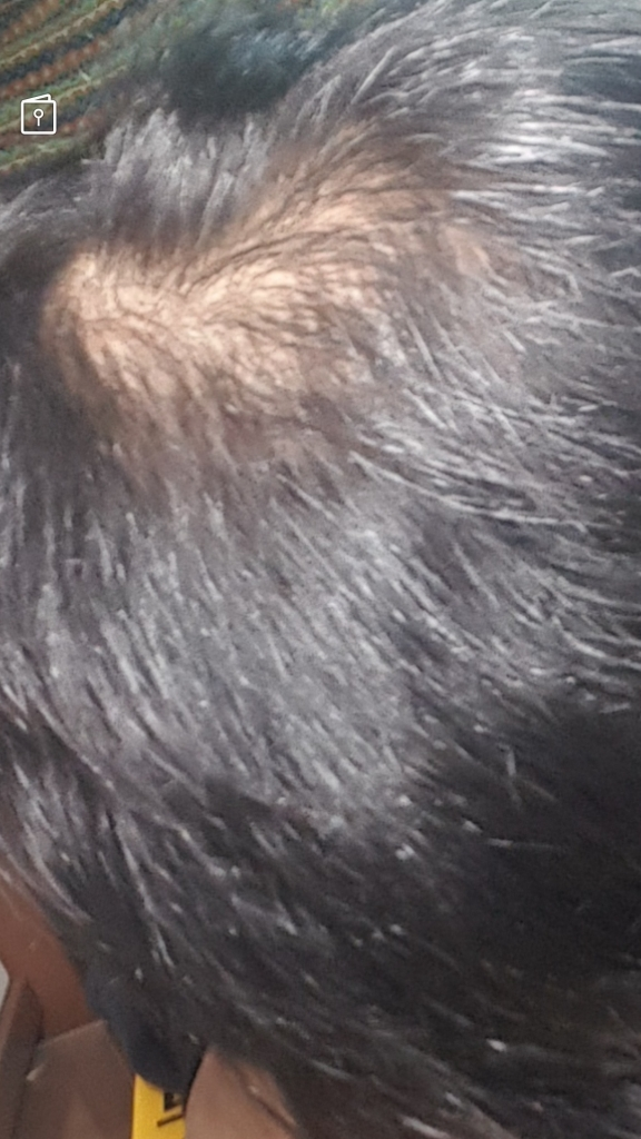 2 years and 5 months of taking Propecia