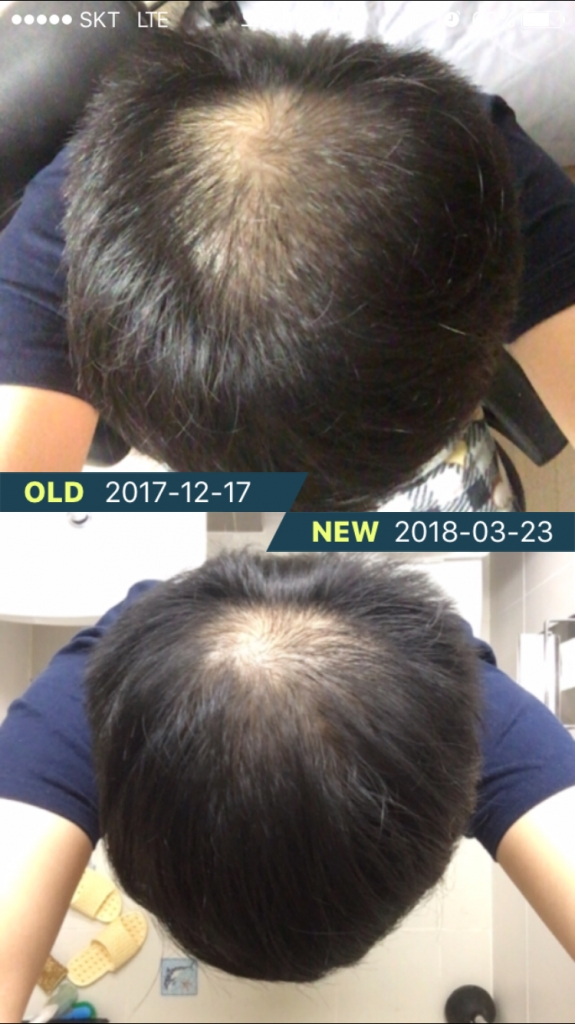 4 months of adot + 2 weeks of minoxidil