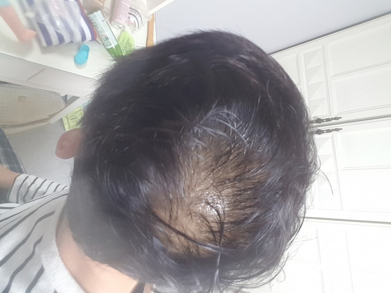 Monapesia+Minoxidil3个月后期。